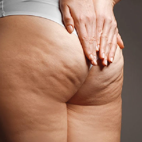 Cellulite dura / compatta