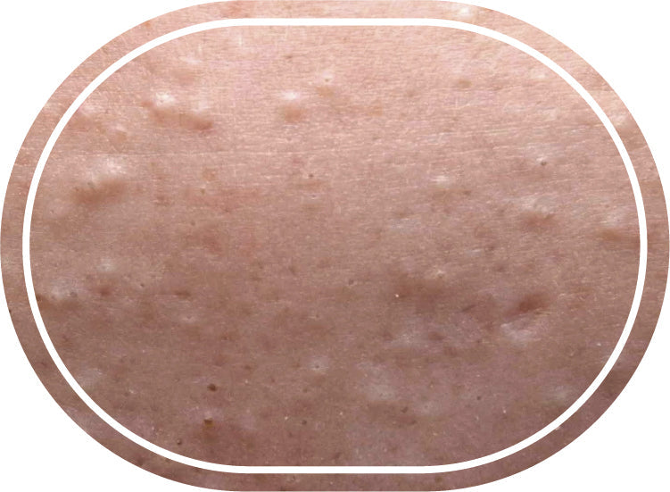 Pelle impura / grassa