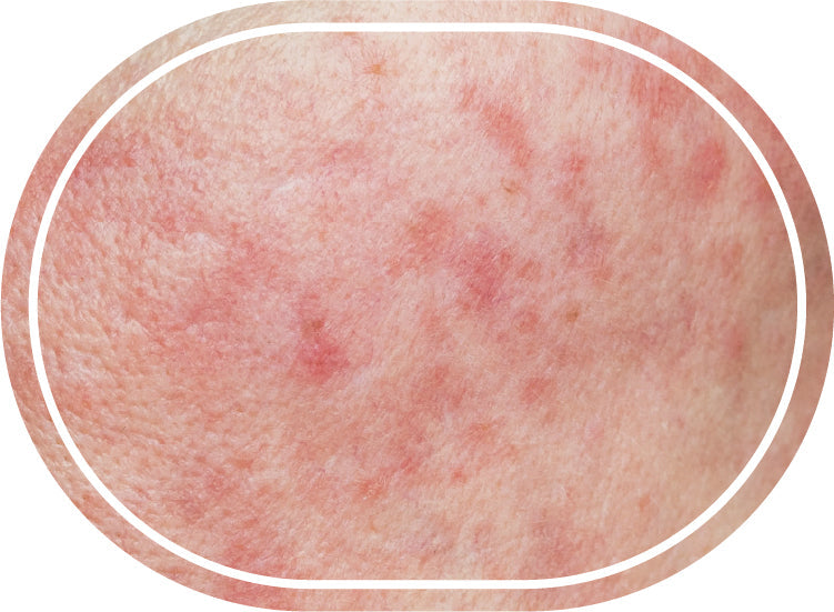 Pelle sensibile / couperose